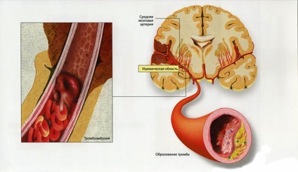 Ateroscleroza arterelor carotide, cauze, simptome, tratament