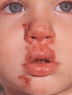 Bakteriális bőrbetegségek
