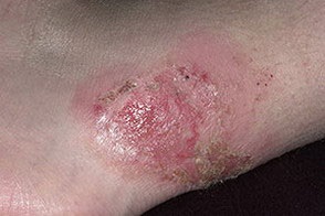 bakteriális bőrbetegségek
