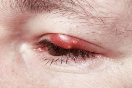 Cauzele și prevenirea bolilor oculare la om