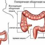 Durerea în colonul sigmoid ca manifestare a sigmoiditei