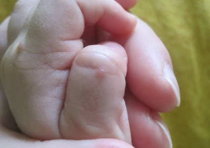 Wart la copil pe tipuri de degete, motivele pentru modul de retragere