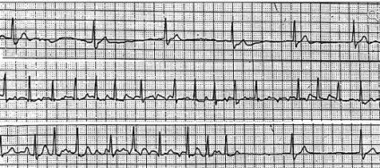 Bradicardia cauzează, tratament, prognostic