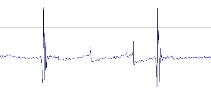 bradycardia szív vezet szívroham és az agyvérzés