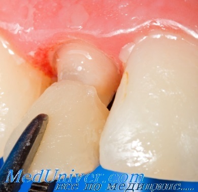 Cimentarea coroanelor temporare și provizorii ale dinților