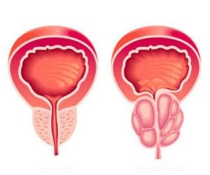 Ceaiul din prostatită, tratamentul prostatitei cu ceai ivan, cum să preparăm ceai în mod adecvat cu adenomul de prostată