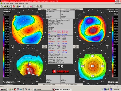 Ce trebuie să faceți dacă sunteți diagnosticat cu keratoconus