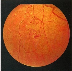 Ce este angiopatia vaselor retinei și cauzele apariției acesteia