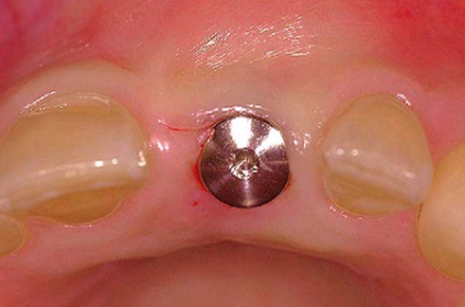 Care este forma de gingiva pentru implantarea dintilor?