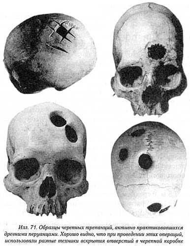 Deformáció és craniotomy - egy különös szokás