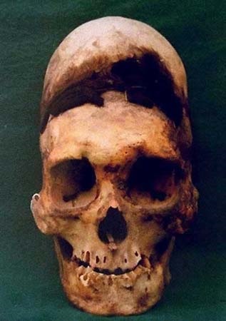 Deformarea și trepanarea craniului este un obicei ciudat