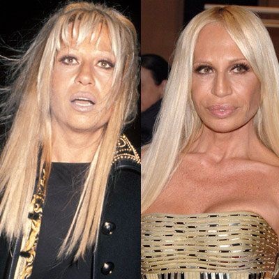 Donatella Versace înainte de operație