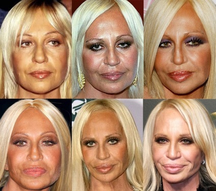 Donatella Versace fotografie înainte și după operație - 300