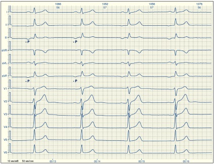 E-cardio ritm supraventricular