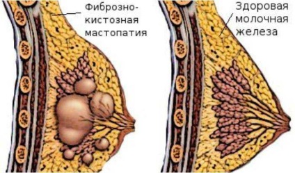 Tratamentul cu mastopatie fibros-chistică cu remedii folclorice