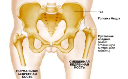 Imaturitatea fiziologică a etiologiei și patogenezei articulațiilor șoldului