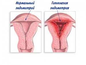 Hipoplazia uterului