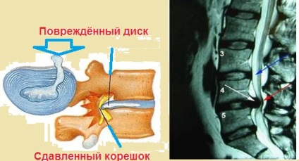 Hernia discului intervertebral al coloanei vertebrale cervicale și lombosacrale