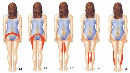 Hernia discului intervertebral al coloanei vertebrale cervicale și lombosacrale