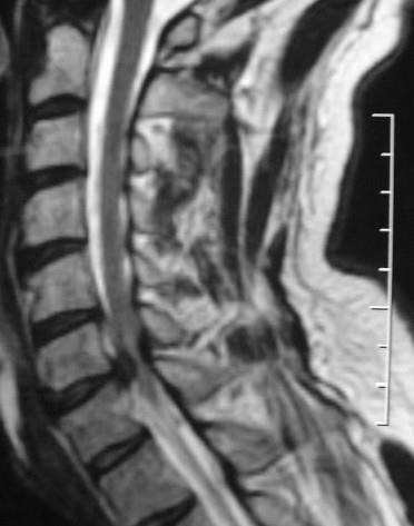 Hernia discului intervertebral al coloanei vertebrale cervicale și lombosacrale