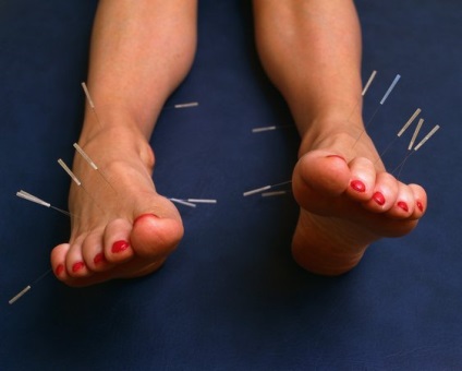 Acupunctura de picioare în Moscova - puncte implicate în acupunctura de picioare - clinica 