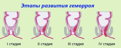 Indovazin cu hemoroizi