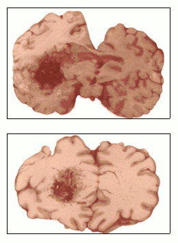 Accident vascular cerebral, enciclopedie