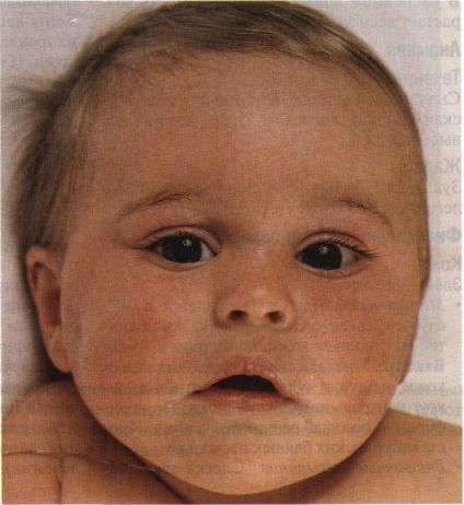 Ichtioza la nou-născuți collodion fetus este cea mai frecventă manifestare a ihtiozelor la nou-născuți