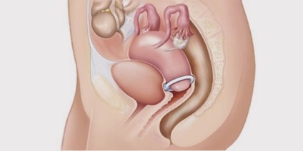 Care este procedura pentru pierderea uterului
