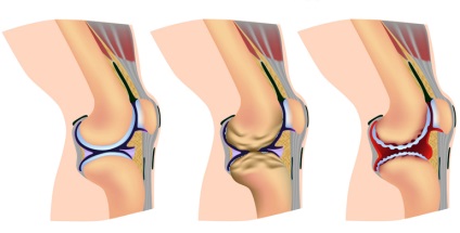 Cum se trateaza artrita genunchiului - cauzele, tipurile, simptomele, tratamentul artritei genunchiului cu remedii folclorice