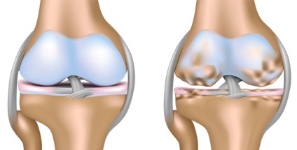 Cum se trateaza artrita genunchiului - cauzele, tipurile, simptomele, tratamentul artritei genunchiului cu remedii folclorice
