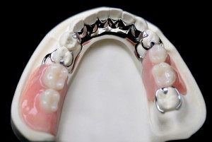 Cum să înlăturați o proteză cu clama pe care se blochează proteza din spate este mai bună, efectul dentar