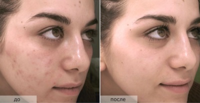 Cum să elimini cicatricile de la acnee pe față - măștile faciale