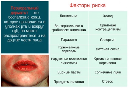 Cum se vindecă cauzele dermatitei periorale și medicamentele naturale