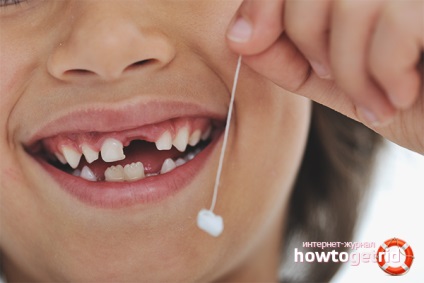 Hogyan húzza ki a fogat gyermek otthon