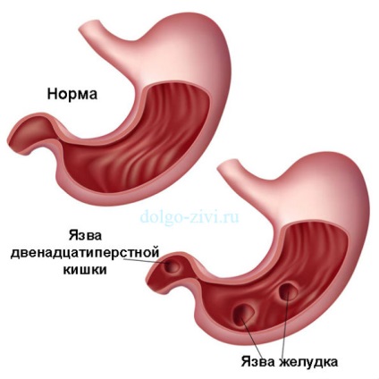 Sucul de varza cu ulcer gastric este un prim ajutor real