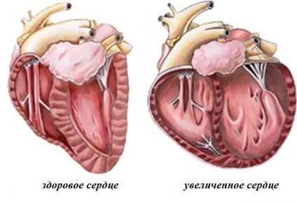 Cauze cardiomegale, simptomatologie, cum să tratăm