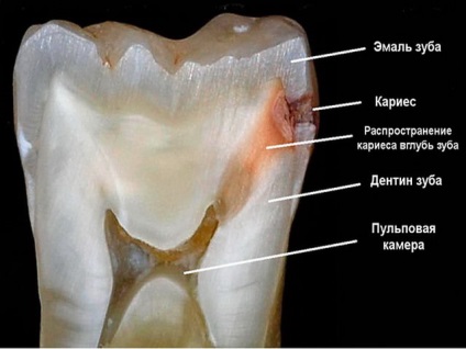 Caries mediu - ca un tratament la domiciliu video