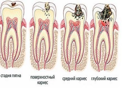 Caries mediu - ca un tratament la domiciliu video