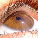 Cataracta ochiului