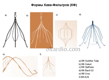 Cava filtru ce este, tipuri, indicații pentru implantare, eficiență