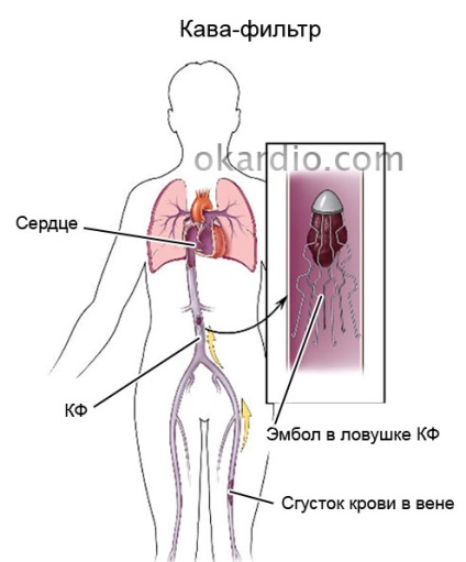 Cava filtru ce este, tipuri, indicații pentru implantare, eficiență