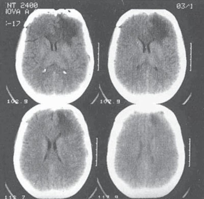 Klinikai besorolása szövődmények traumás agysérülés
