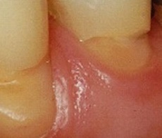 Cuneoid defecte foto dentare, cauze și tratament