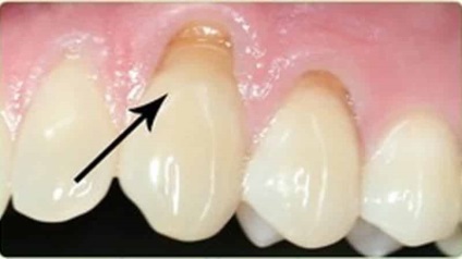 Cuneoid cauze defecte de dinte și tratament, fotografie