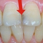 Cuneoid cauze defecte de dinte și tratament, fotografie