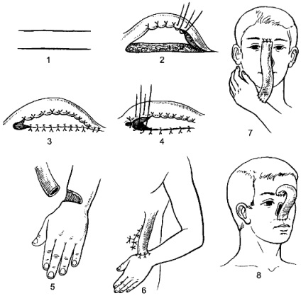 dermepenthesis