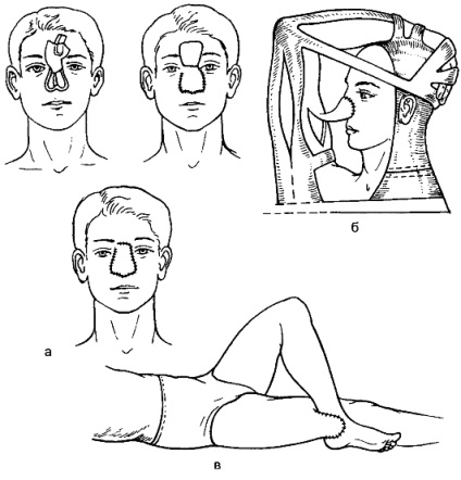 dermepenthesis