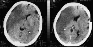 Ct din imaginile creierului de diferite patologii