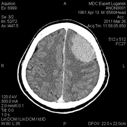 Ct din imaginile creierului de diferite patologii